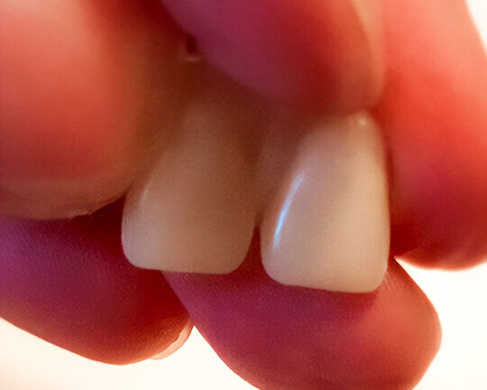 Dvě spojené náhradní přední korunky Denticor při pohledu zepředu