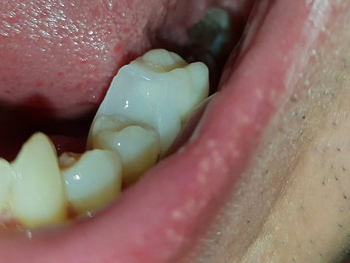 Nasazení přizpůsobené náhrady Denticor na místo chybějícího zadního zubu