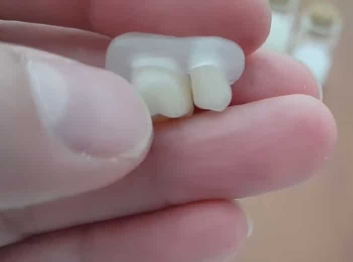 Dvě korunky spojené můstkem z materiálu DentiFlex, pohled zezadu