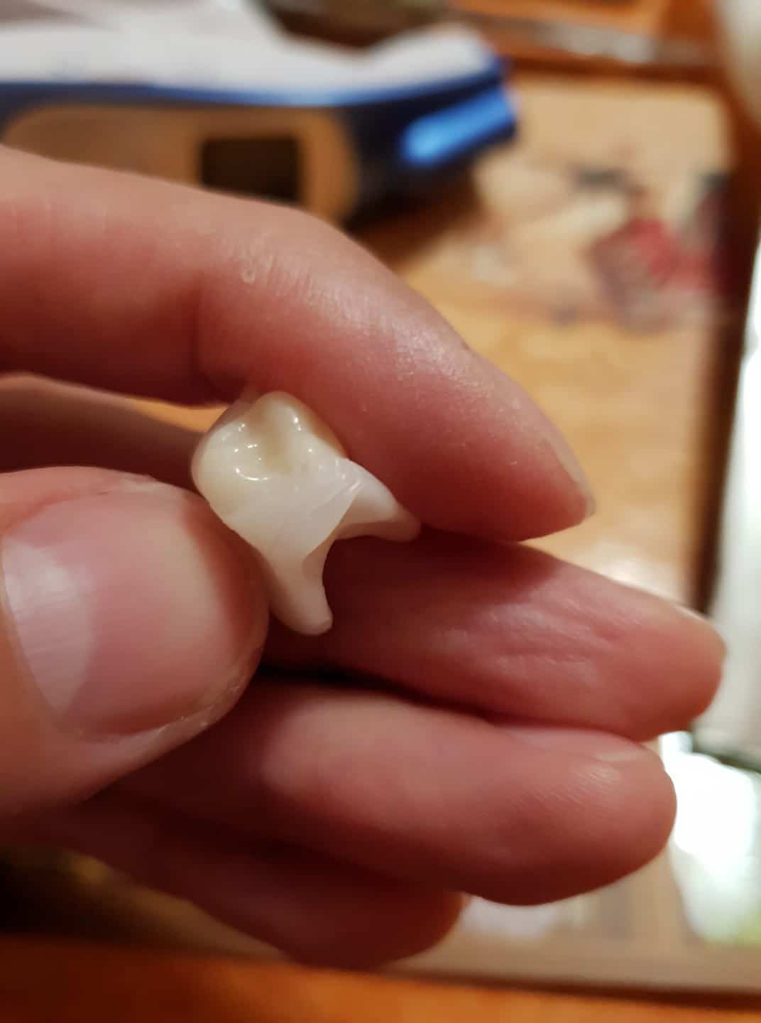 Finální zubní náhrada Denticor po měsících vývoje