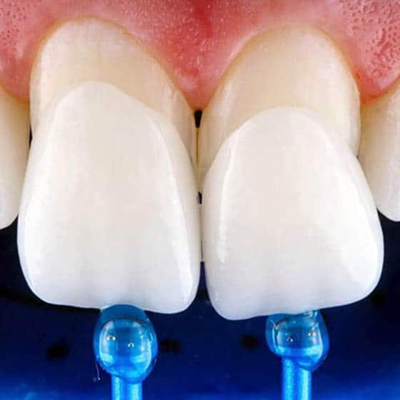 Fazety Denticor – estetické překrytí předních zubů