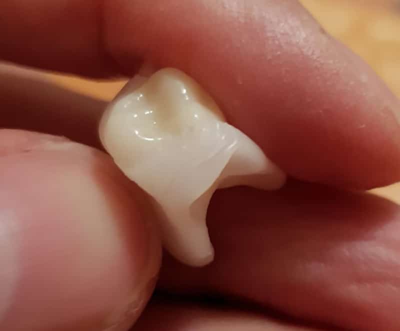 Detail pryskyřičné korunky Denticor s můstkem DentiFlex