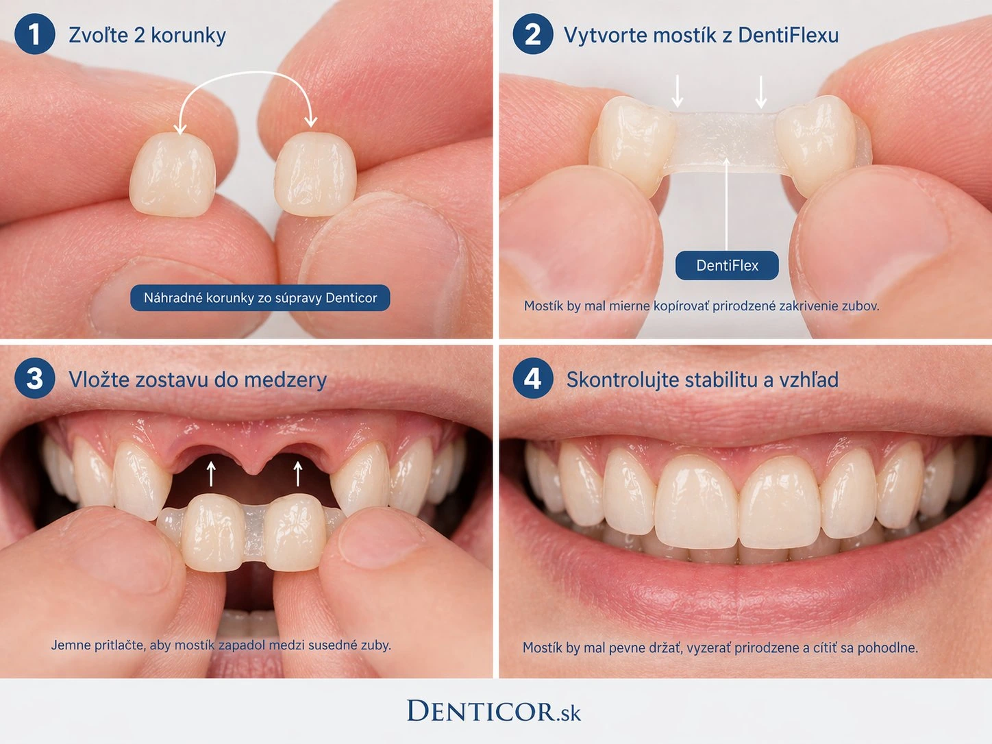Jak funguje Denticor v případě chybějících dvou dolních premolárů