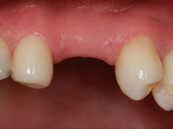 Postup Denticor pro špičák: zahojená mezera, korunka v systému DentiFlex, vložení mezi zuby a tenký finální můstek