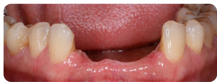 Ukázka nasazení Denticor pro dolní špičák a dva premoláry: umístění náhrady a tvarování její opory proti sousedním zubům