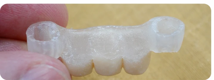 Ukázka nasazení Denticor pro dolní špičák a dva premoláry: umístění náhrady a tvarování její opory proti sousedním zubům