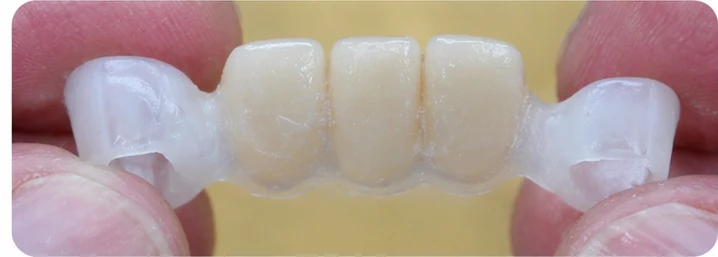 Ukázka nasazení Denticor pro dolní špičák a dva premoláry: umístění náhrady a tvarování její opory proti sousedním zubům
