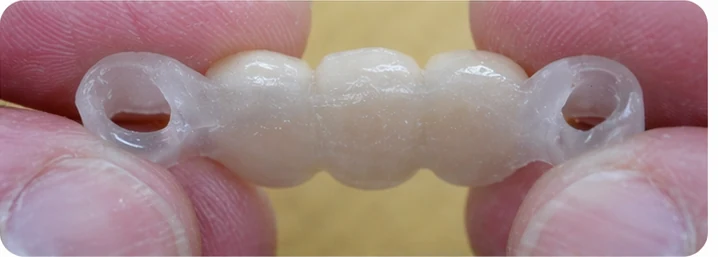 Ukázka nasazení Denticor pro dolní špičák a dva premoláry: umístění náhrady a tvarování její opory proti sousedním zubům
