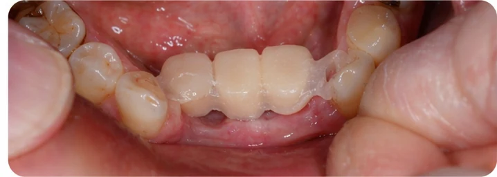 Ukázka nasazení Denticor pro dolní špičák a dva premoláry: umístění náhrady a tvarování její opory proti sousedním zubům