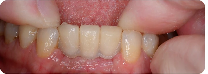Ukázka nasazení Denticor pro dolní špičák a dva premoláry: umístění náhrady a tvarování její opory proti sousedním zubům