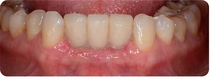 Ukázka nasazení Denticor pro dolní špičák a dva premoláry: umístění náhrady a tvarování její opory proti sousedním zubům