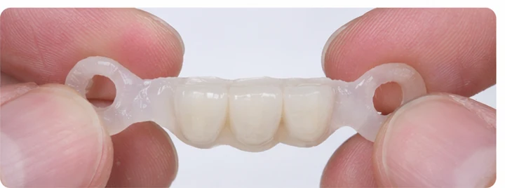 Vizuální postup pro tři sousední zuby v dolním oblouku – princip vložení Denticorového můstku s novými zuby a jeho dotvarování kolem okolních zubů
