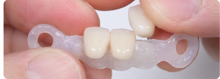 Vizuální postup pro tři sousední zuby v dolním oblouku – princip vložení Denticorového můstku s novými zuby a jeho dotvarování kolem okolních zubů