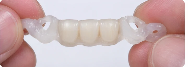 Vizuální postup pro tři sousední zuby v dolním oblouku – princip vložení Denticorového můstku s novými zuby a jeho dotvarování kolem okolních zubů