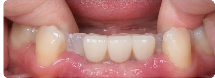 Vizuální postup pro tři sousední zuby v dolním oblouku – princip vložení Denticorového můstku s novými zuby a jeho dotvarování kolem okolních zubů