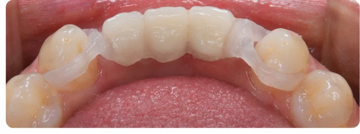 Vizuální postup pro tři sousední zuby v dolním oblouku – princip vložení Denticorového můstku s novými zuby a jeho dotvarování kolem okolních zubů