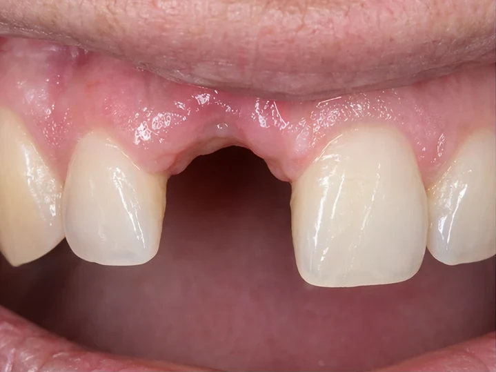 Pohled zepředu: chybějící přední zub, korunka v DentiFlexu, zasazení mezi sousední zuby a výsledek