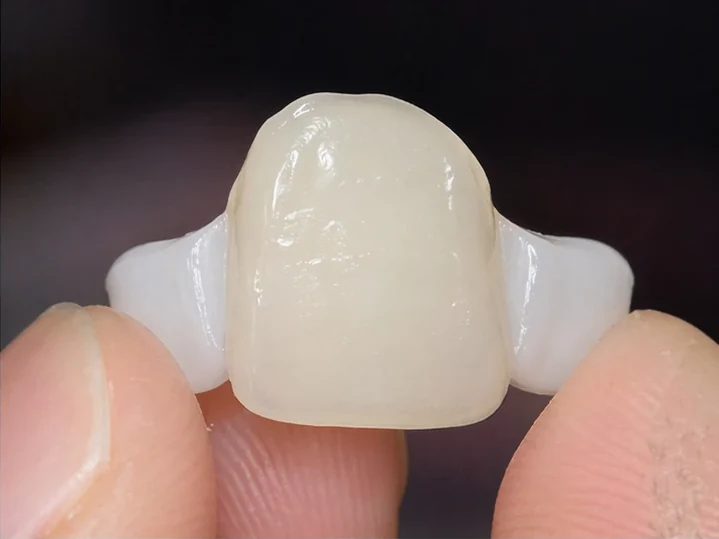 Pohled zepředu: chybějící přední zub, korunka v DentiFlexu, zasazení mezi sousední zuby a výsledek