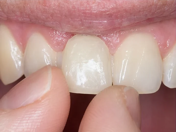 Pohled zepředu: chybějící přední zub, korunka v DentiFlexu, zasazení mezi sousední zuby a výsledek