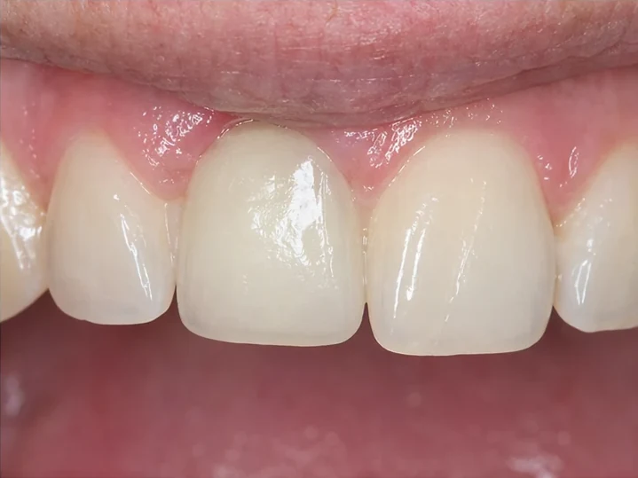 Pohled zepředu: chybějící přední zub, korunka v DentiFlexu, zasazení mezi sousední zuby a výsledek