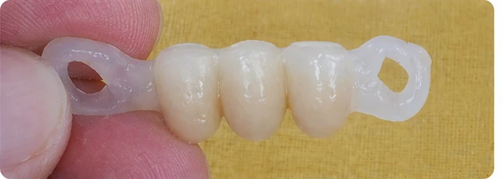 Vizuální postup pro dva premoláry a horní stoličku – princip nasazení můstku Denticor s novými zuby a jeho přizpůsobení okolním zubům
