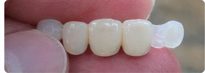 Ukázka nasazení Denticor: umístění náhrady a tvarování jejího nosiče DentiFlex · 3