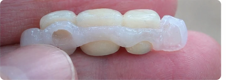Ukázka nasazení Denticor: umístění náhrady a tvarování jejího nosiče DentiFlex · 4