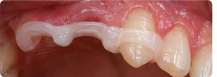 Ukázka nasazení Denticor: umístění náhrady a tvarování jejího nosiče DentiFlex · 6