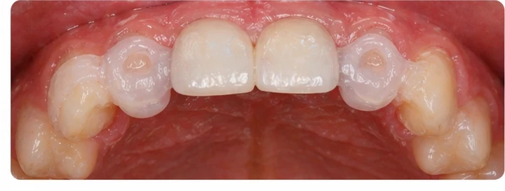 Ukázka nasazení Denticor: umístění náhrady a tvarování jejího nosiče DentiFlex · 7