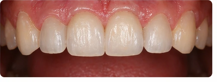 Ukázka nasazení Denticor: umístění náhrady a tvarování jejího nosiče DentiFlex · 8