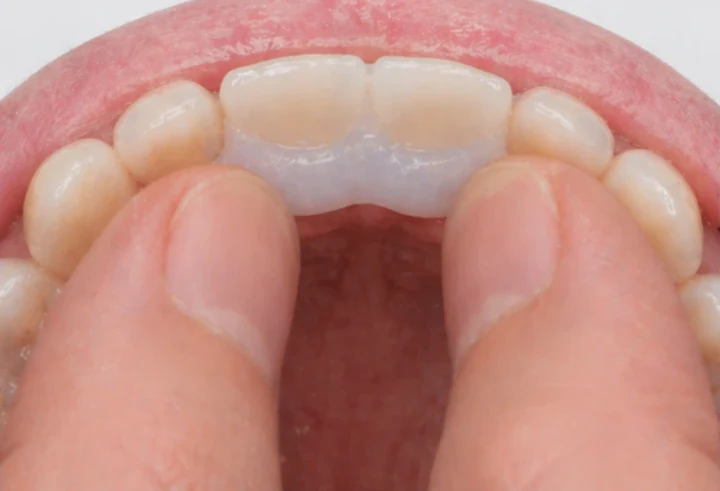 Denticor pro horní dva střední řezáky – pohled zezadu od patra: tvar můstku a dosednutí za novými zuby