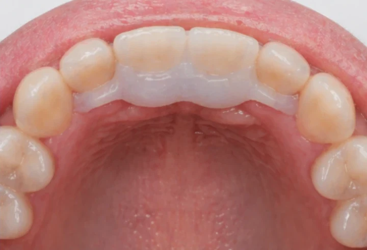 Denticor pro horní dva střední řezáky – pohled zezadu od patra: tvar můstku a dosednutí za novými zuby