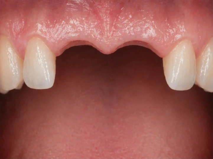 Denticor pro horní dva střední řezáky – pohled zepředu: mezera, připravená náhrada, vložení a výsledek