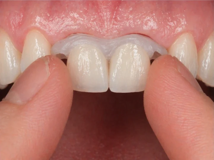 Denticor pro horní dva střední řezáky – pohled zepředu: mezera, připravená náhrada, vložení a výsledek