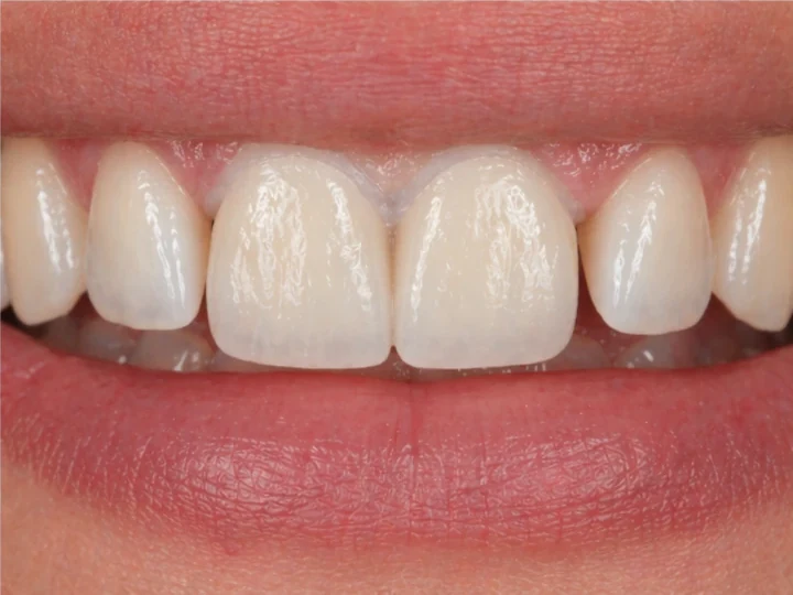 Denticor pro horní dva střední řezáky – pohled zepředu: mezera, připravená náhrada, vložení a výsledek