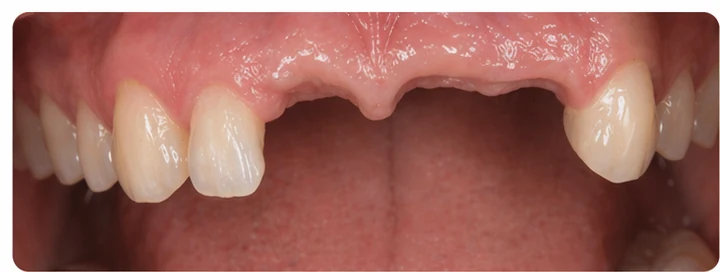 Ukázka nasazení Denticor: umístění náhrady a tvarování jejího nosiče DentiFlex · 1