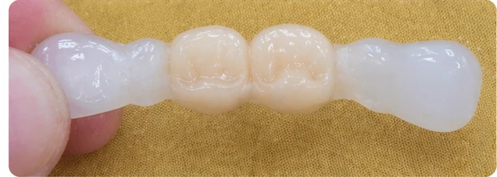 Ukázka nasazení Denticor: umístění náhrady a tvarování jejího nosiče DentiFlex · 3