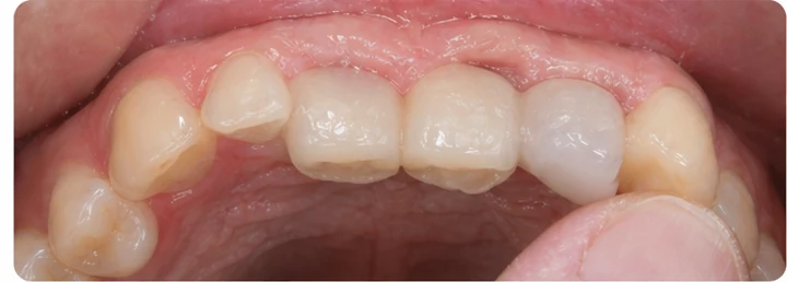 Ukázka nasazení Denticor: umístění náhrady a tvarování jejího nosiče DentiFlex · 5