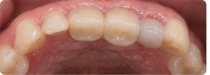 Ukázka nasazení Denticor: umístění náhrady a tvarování jejího nosiče DentiFlex · 6