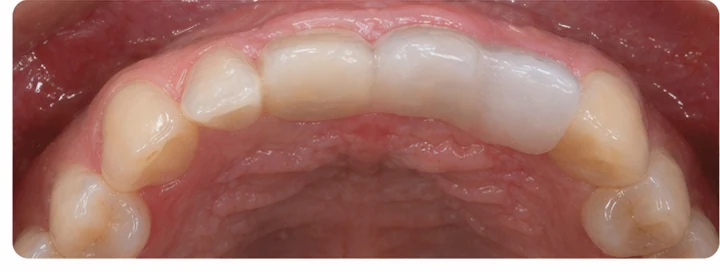 Ukázka nasazení Denticor: umístění náhrady a tvarování jejího nosiče DentiFlex · 7