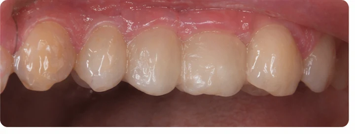 Ukázka nasazení Denticor: umístění náhrady a tvarování jejího nosiče DentiFlex · 8
