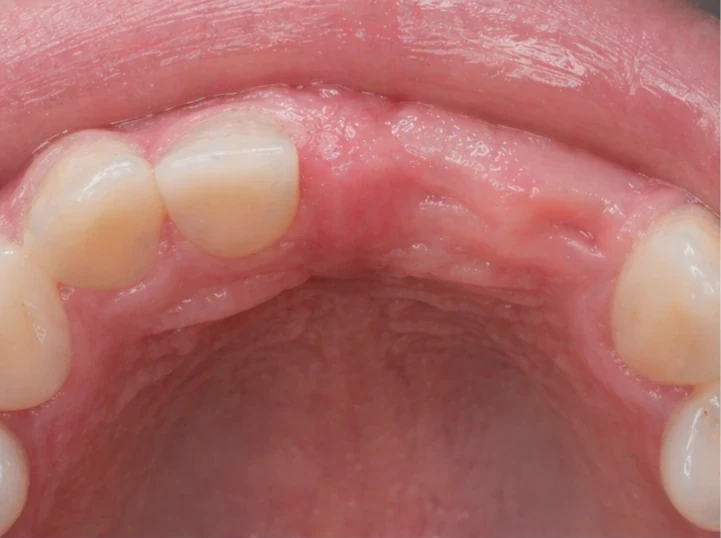 Denticor pro horní střední a boční řezák – pohled zezadu od patra: tvar můstku a dosednutí za novými zuby