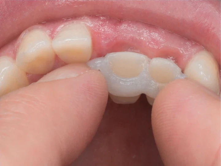 Denticor pro horní střední a boční řezák – pohled zezadu od patra: tvar můstku a dosednutí za novými zuby
