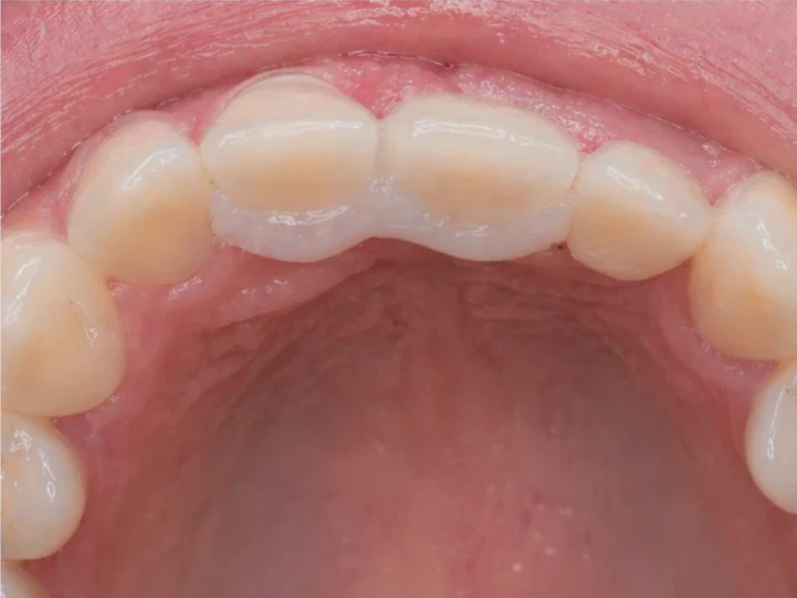 Denticor pro horní střední a boční řezák – pohled zezadu od patra: tvar můstku a dosednutí za novými zuby