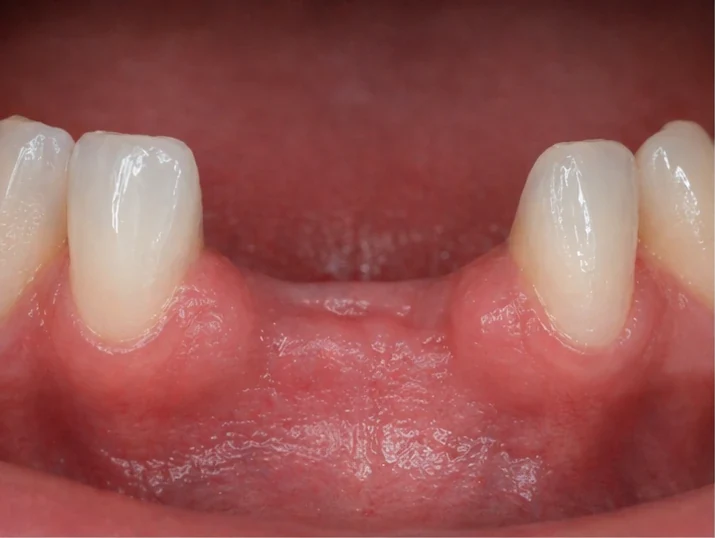 Denticor – rychlá náhrada dvou dolních předních řezáků: mezera, připravený můstek DentiFlex se dvěma zuby, vložení jako celek a výsledek