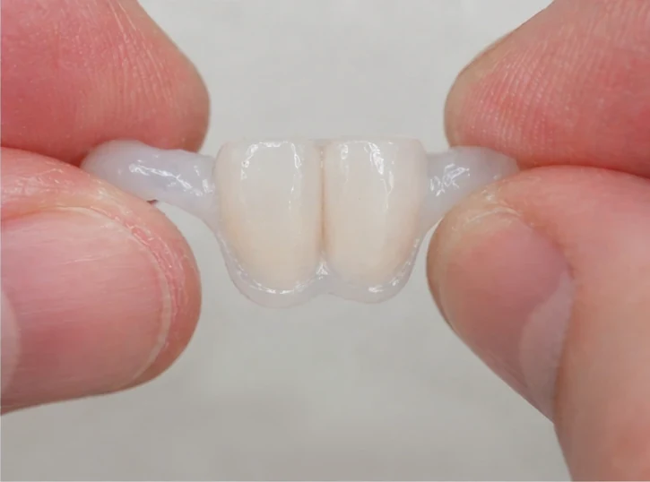 Denticor – rychlá náhrada dvou dolních předních řezáků: mezera, připravený můstek DentiFlex se dvěma zuby, vložení jako celek a výsledek