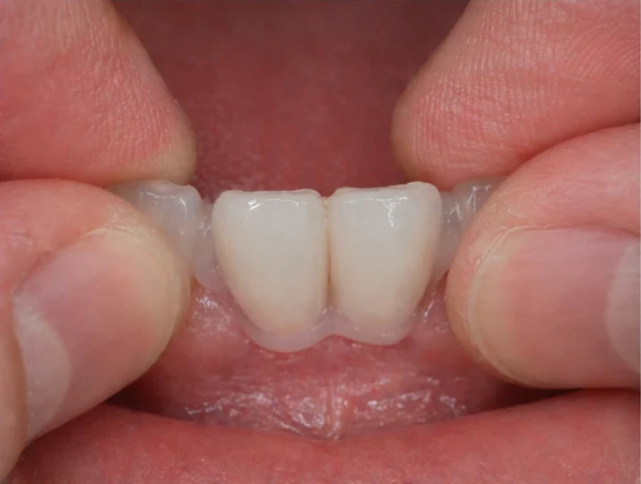 Denticor – rychlá náhrada dvou dolních předních řezáků: mezera, připravený můstek DentiFlex se dvěma zuby, vložení jako celek a výsledek