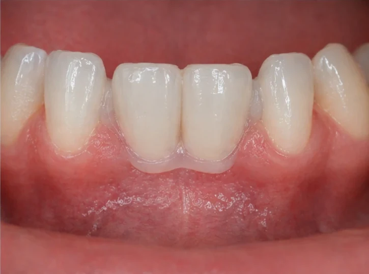 Denticor – rychlá náhrada dvou dolních předních řezáků: mezera, připravený můstek DentiFlex se dvěma zuby, vložení jako celek a výsledek