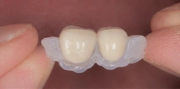 Vizuální postup vložení a dotvarování náhrady – horní dva premoláry