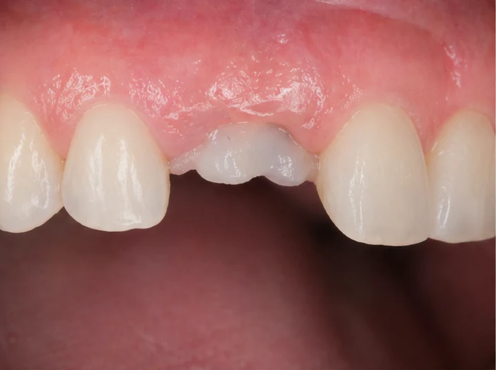 Postup Denticor pro špičák: zahojená mezera, korunka v systému DentiFlex, vložení mezi zuby a tenký finální můstek
